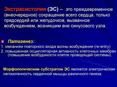 Экстрасистолия