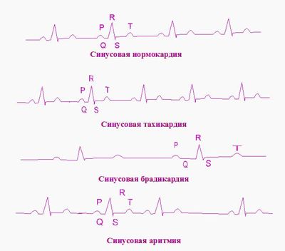 Виды разлада сердечного ритма
