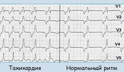 Тахикардия на ЭКГ