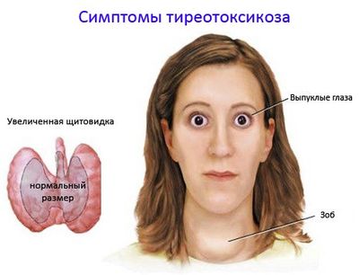 Тиреотоксикоз