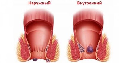 Виды геморроя