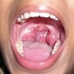 Лечение хронического тонзиллита народными средствами: как лечить ангину