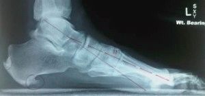 Лечение пяточной шпоры в домашних условиях
