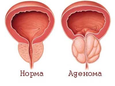 аденома предстательной железы