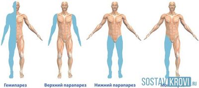 Прогрессирующая мультифокальная