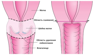 ампутация шейки матки