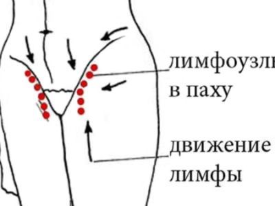 Почему у женщин происходит воспаление лимфоузлов в паху, как это лечить?