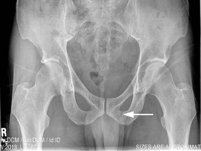 Перелом