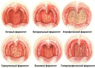 Менингококковая инфекция у детей и взрослых: виды, симптоматика и лечение
