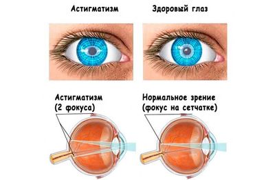 симптомы астигматизма