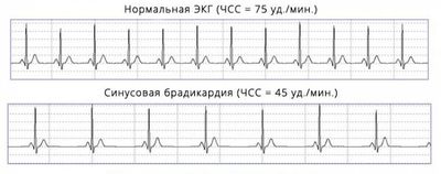 Брадиаритмия