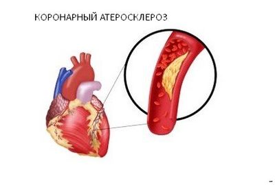 Что такое микроинфаркт, его симптомы, лечение и прогноз
