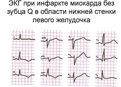 Инфаркт без зубца Q на ЭКГ