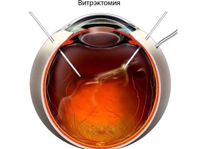 Принцип витрэктомии