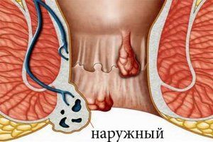 Кто подвержен появлению геморроя