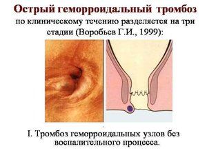 Разновидности форм геморроя