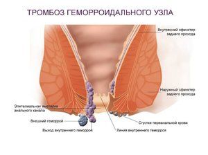 Наружный геморрой