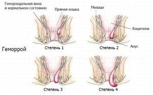 Как питаться при геморрое