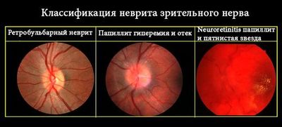 Классификация неврита зрительного нерва