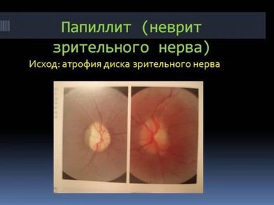 Неврит зрительного нерва: симптомы патологии