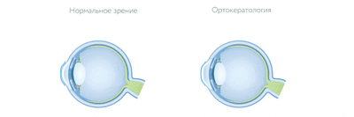 ортокератологические линзы