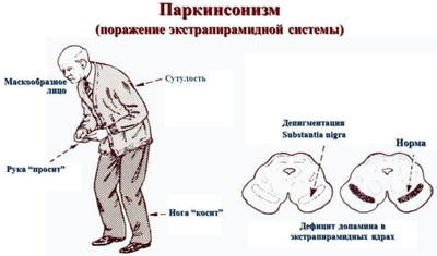 Симптомы болезни Паркинсона