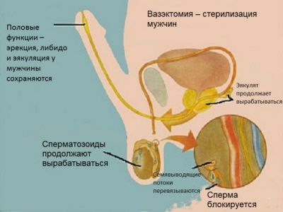 Вазэктомия у мужчины