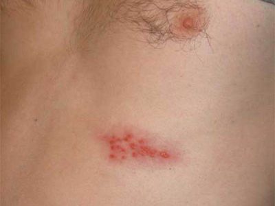 Заболевание кожи опоясывающий лишай
