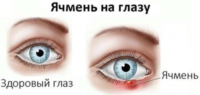 Опух глаз - насколько это опасно и что делать