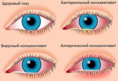Симптомы и виды конъюнктивита