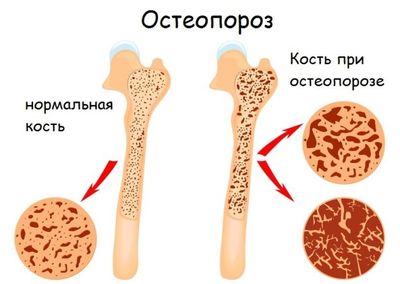 Остеопороз костей - что это за болезнь, ее признаки и лечение
