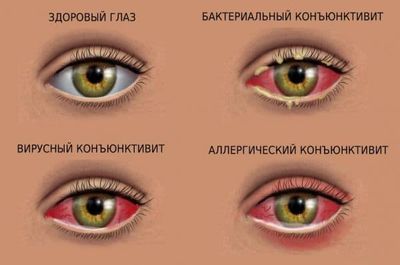 Отёкшие веки: причины и методы лечения