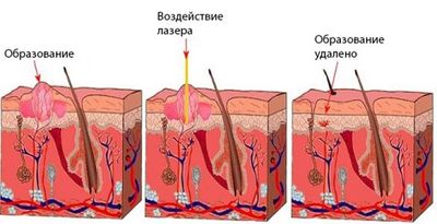 воздействие лазера на папиллому