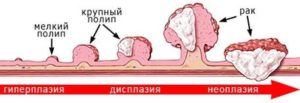 Папилломы на спине: причины появления, лечение и профилактика