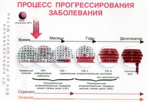Папилломы на спине: причины появления, лечение и профилактика