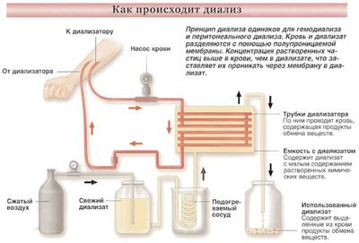 Гемодиализ