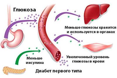 Сахарный диабет 1 типа