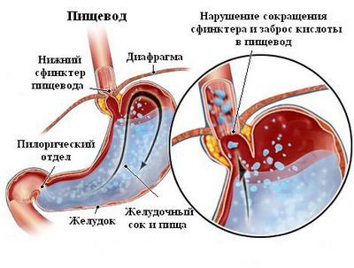 Пептический эзофагит: формы, стадии и лечение