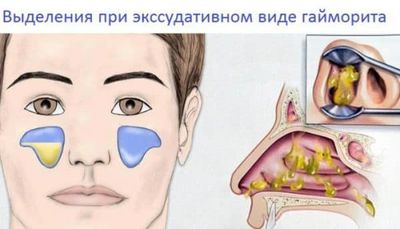 Признаки гайморита, его симптомы первые - где болит у взрослых