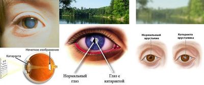 Симптомы катаракты