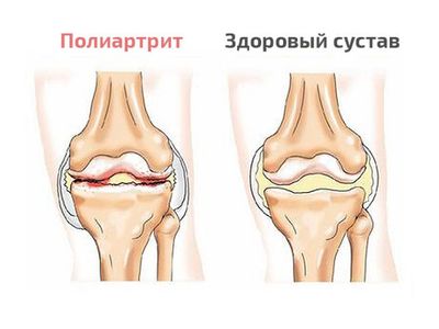 Что такое полиартрит: виды, классификация и правила лечения