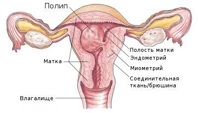 Полип эндометрия в матке