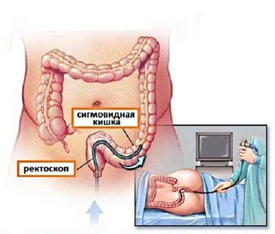 Ректоскопия