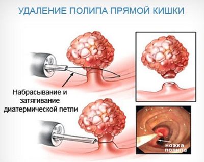 Эндоскопическая полипэктомия