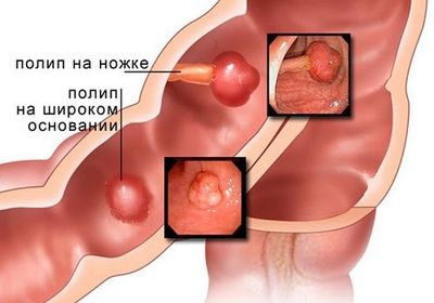 Опасность полипа поджелудочной железы