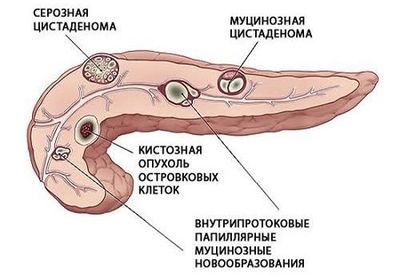 Кисты и опухоли в ПЖ