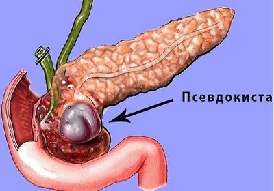 Псевдокиста
