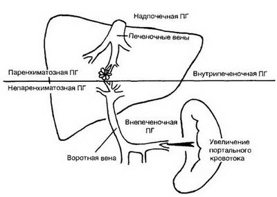 Портальная гипертензия