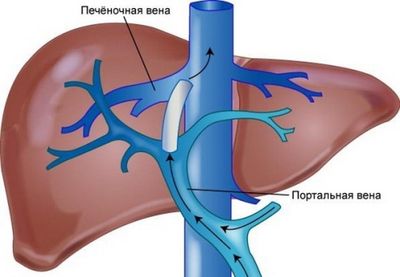 Портальная гипертензия при циррозе