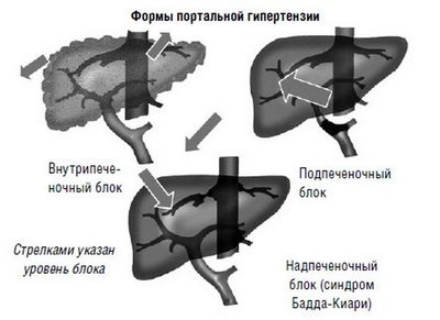 Формы портальной гипертензии